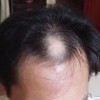 常见的脱发类型有哪些