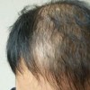 青岛久病成医治疗脱发