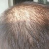 青岛如何治疗脱发好