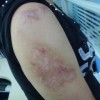 下肢烧伤性疤痕护理原则