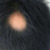 斑秃吃药要吃多长时间