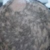 斑秃的出现具体是由什么因素导致的