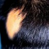 斑秃的病因主要有哪些表现