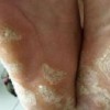 皲裂型手足癣症状图片