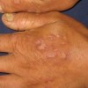 手足癣病人在日常里怎样预防传染伤害呢