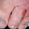 手足癣传染如何防止