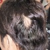 斑秃能预防吗