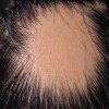 发生斑秃的病因有哪些