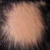 哪些因素会导致斑秃的发生