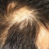 导致斑秃发生的病因有什么