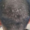 吃什么食物对治疗斑秃有益