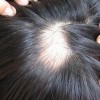 女性斑秃的有关治疗方式是什么