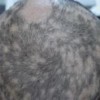斑秃有哪些治疗上的误区呢
