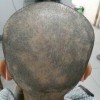 斑秃治疗最快的办法