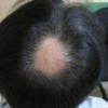斑秃治疗需要多少钱