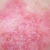 脓疱疮诊断和并发症介绍