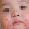 儿童脓疱疮的预防措施是什么
