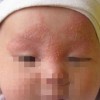 脓疱疮病因是啥