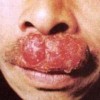宝宝患脓疱疮的原因