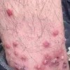 传染性脓疱疮的严重情况