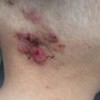患有脓疱疮的病患要注意卫生