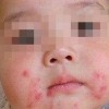 患小儿脓疱疮需要注意些什么