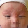 对于新生儿脓疱疮的有效措施