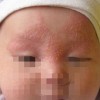 青岛脓疱疮不治疗会怎样