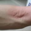 慢性荨麻疹怎么根治