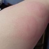 丘疹性荨麻疹的发病特点图