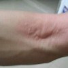 丘疹性荨麻疹患者日常需注意什么