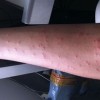 慢性荨麻疹为什么难治呢
