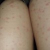 丘疹荨麻疹症