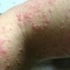 患有荨麻疹平时需要注意些什么