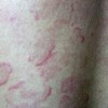 丘疹性荨麻疹吃什么中药