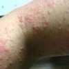 青岛丘疹性荨麻疹的常见治疗的手法
