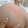 青岛人工荨麻疹的治疗