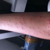 青岛慢性荨麻疹的治疗