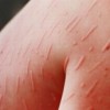 青岛慢性荨麻疹怎样治疗呢