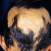 怎么正确预防斑秃发生呢