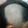治疗斑秃偏方