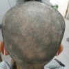 治疗斑秃的秘方