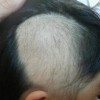 怎么治疗斑秃好