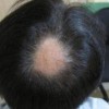 治疗斑秃的费用