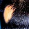 治疗斑秃的最佳措施是什么
