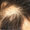 治疗斑秃注意的重点