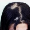 怎么样治疗女性斑秃好