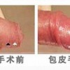 包皮过长需要做哪些化验检查
