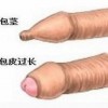 引起包皮过长的病因有什么
