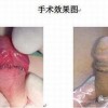诱发包皮过长的病因有什么